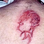 Allergic reactions to time tattoos